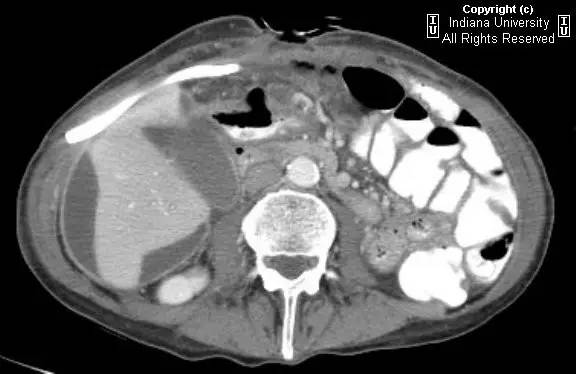 【病例】胃溃疡穿孔1例CT