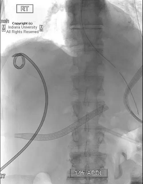 【病例】胃溃疡穿孔1例CT