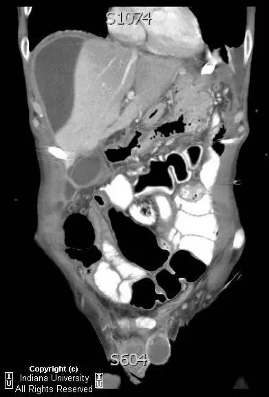 【病例】胃溃疡穿孔1例CT