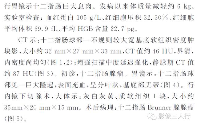【病例】十二指肠Brunner腺腺瘤1例CT影像表现 【病例】十二指肠Brunner腺腺瘤1例CT影像表现