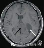 【病例】颅内神经节胶质瘤1例CT及MR影像表现 【病例】颅内神经节胶质瘤1例CT及MR影像表现