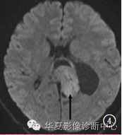 【病例】颅内神经节胶质瘤1例CT及MR影像表现 【病例】颅内神经节胶质瘤1例CT及MR影像表现
