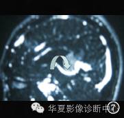 【病例】颅内神经节胶质瘤1例CT及MR影像表现 【病例】颅内神经节胶质瘤1例CT及MR影像表现