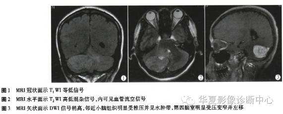 【病例】小脑幕区血管周细胞瘤MR影像及病理分析1例