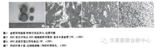 【病例】小脑幕区血管周细胞瘤MR影像及病理分析1例
