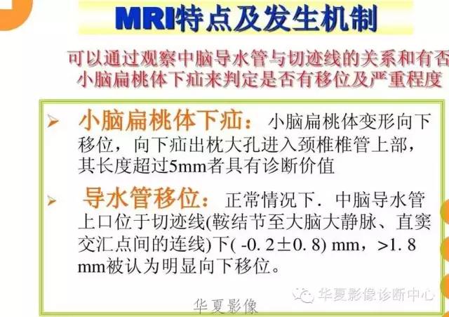 【病例】低颅压综合征IHS一例MR影像表现