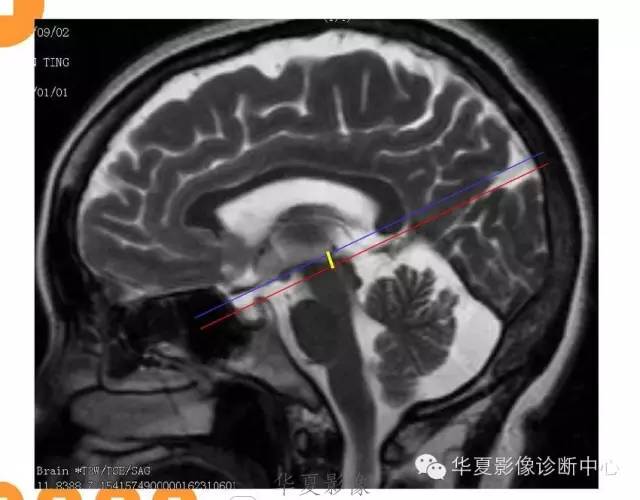 【病例】低颅压综合征IHS一例MR影像表现