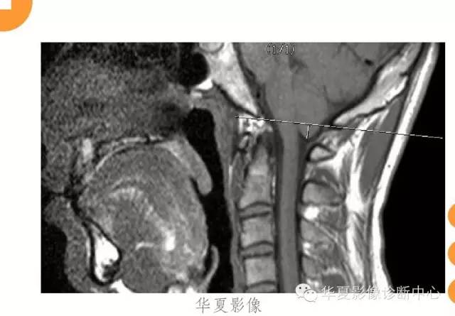 【病例】低颅压综合征IHS一例MR影像表现