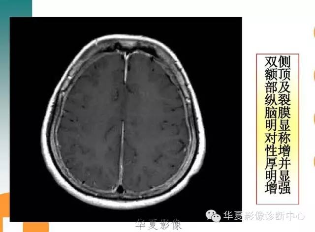 【病例】低颅压综合征IHS一例MR影像表现