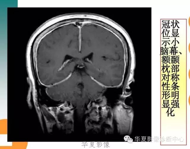 【病例】低颅压综合征IHS一例MR影像表现