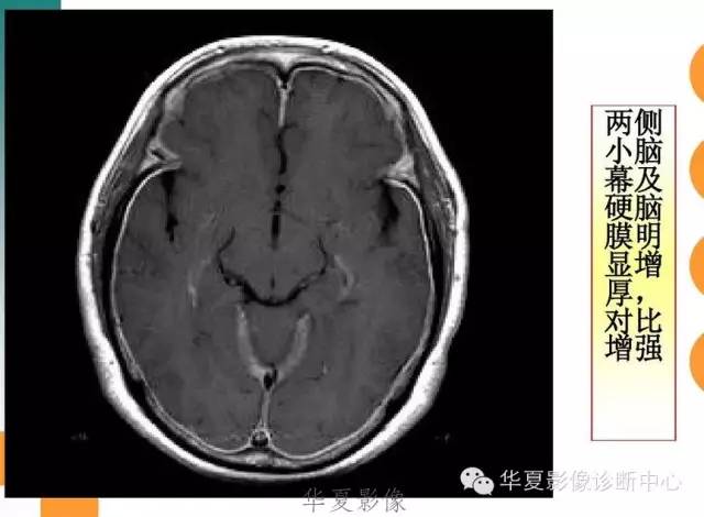 【病例】低颅压综合征IHS一例MR影像表现