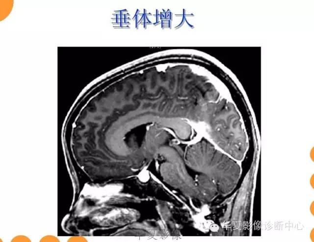 【病例】低颅压综合征IHS一例MR影像表现
