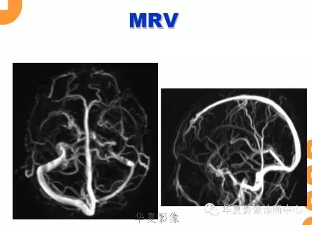 【病例】低颅压综合征IHS一例MR影像表现