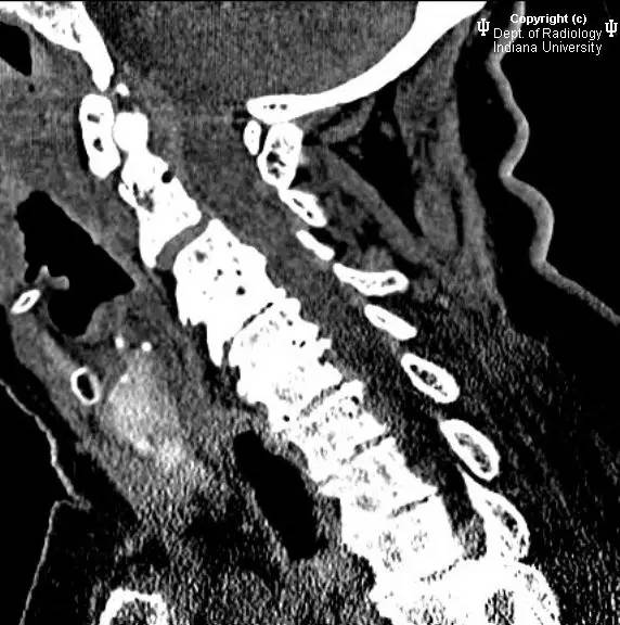 【病例】类风湿性关节炎累及颈椎1例CT及MR影像表现 【病例】类风湿性关节炎累及颈椎1例CT及MR影像表现