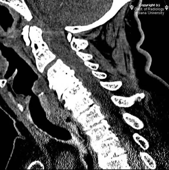 【病例】类风湿性关节炎累及颈椎1例CT及MR影像表现 【病例】类风湿性关节炎累及颈椎1例CT及MR影像表现