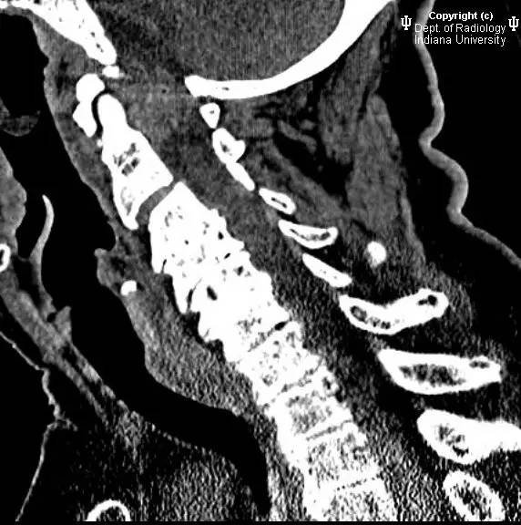 【病例】类风湿性关节炎累及颈椎1例CT及MR影像表现 【病例】类风湿性关节炎累及颈椎1例CT及MR影像表现