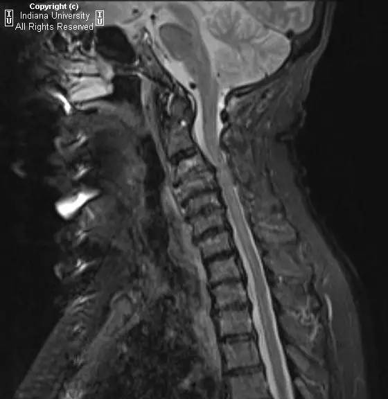 【病例】类风湿性关节炎累及颈椎1例CT及MR影像表现 【病例】类风湿性关节炎累及颈椎1例CT及MR影像表现