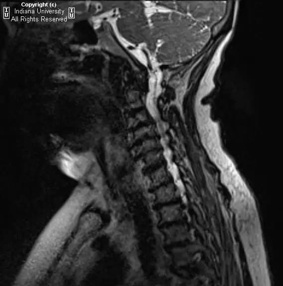 【病例】类风湿性关节炎累及颈椎1例CT及MR影像表现 【病例】类风湿性关节炎累及颈椎1例CT及MR影像表现