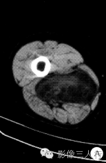 【病例】右大腿硬化性脂肪肉瘤1例CT及MR影像表现与分析