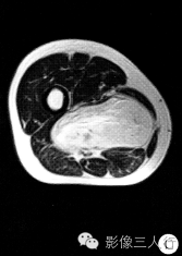 【病例】右大腿硬化性脂肪肉瘤1例CT及MR影像表现与分析