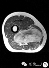 【病例】右大腿硬化性脂肪肉瘤1例CT及MR影像表现与分析