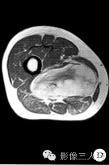 【病例】右大腿硬化性脂肪肉瘤1例CT及MR影像表现与分析