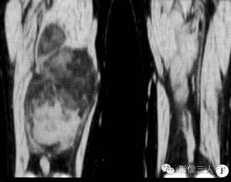 【病例】右大腿硬化性脂肪肉瘤1例CT及MR影像表现与分析