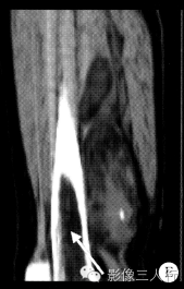 【病例】右大腿硬化性脂肪肉瘤1例CT及MR影像表现与分析