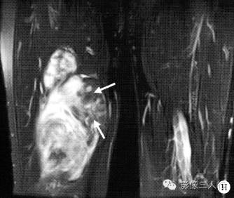 【病例】右大腿硬化性脂肪肉瘤1例CT及MR影像表现与分析