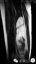 【病例】右大腿硬化性脂肪肉瘤1例CT及MR影像表现与分析