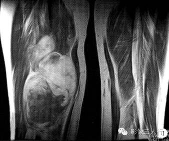 【病例】右大腿硬化性脂肪肉瘤1例CT及MR影像表现与分析