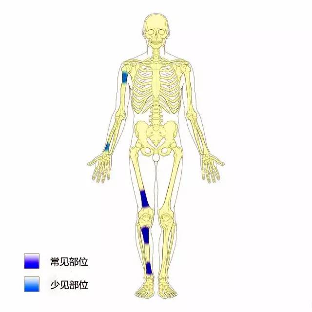 纤维骨皮质缺损与非骨化性纤维瘤 纤维骨皮质缺损与非骨化性纤维瘤