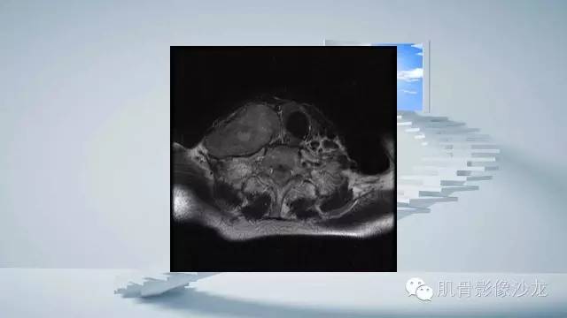 【病例】恶性外周神经鞘瘤2例MR影像表现