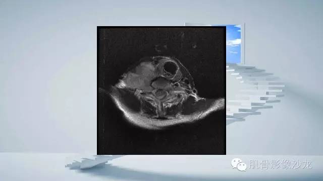 【病例】恶性外周神经鞘瘤2例MR影像表现