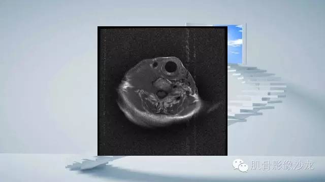 【病例】恶性外周神经鞘瘤2例MR影像表现