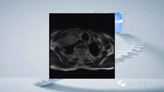 【病例】恶性外周神经鞘瘤2例MR影像表现