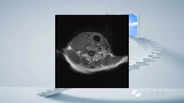 【病例】恶性外周神经鞘瘤2例MR影像表现