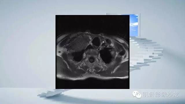 【病例】恶性外周神经鞘瘤2例MR影像表现