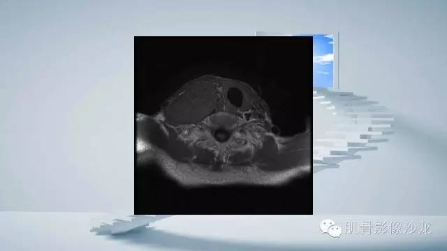 【病例】恶性外周神经鞘瘤2例MR影像表现