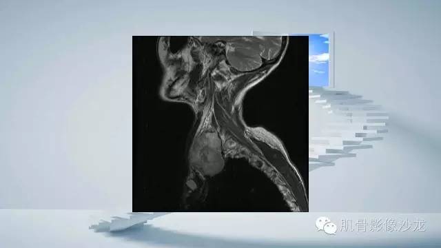 【病例】恶性外周神经鞘瘤2例MR影像表现