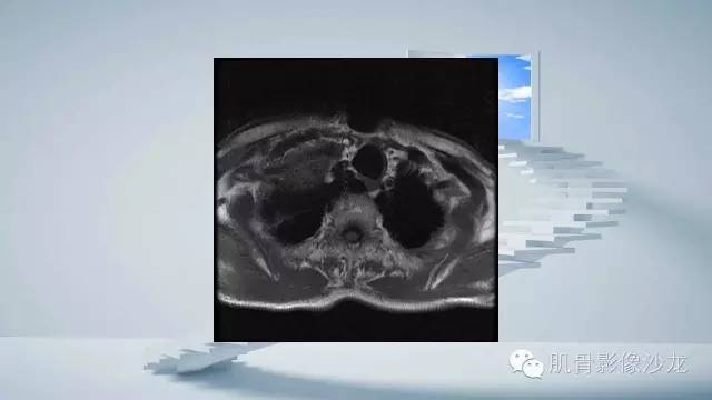 【病例】恶性外周神经鞘瘤2例MR影像表现