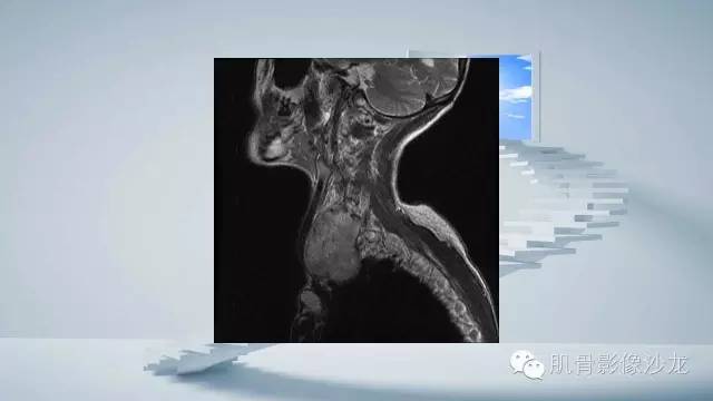 【病例】恶性外周神经鞘瘤2例MR影像表现