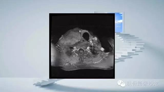 【病例】恶性外周神经鞘瘤2例MR影像表现