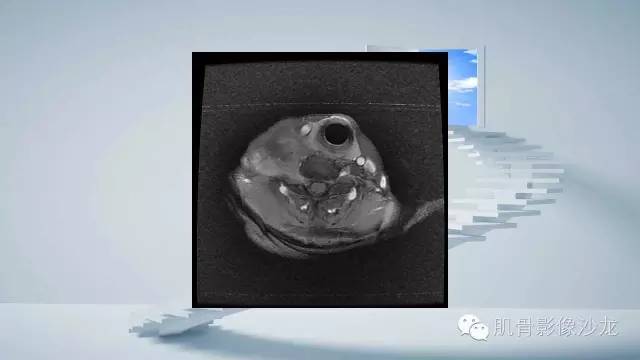 【病例】恶性外周神经鞘瘤2例MR影像表现
