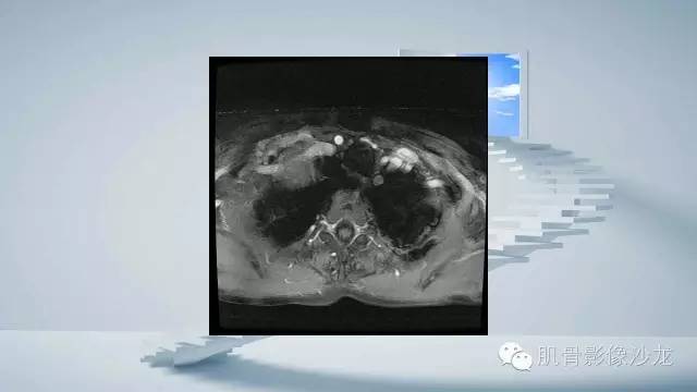 【病例】恶性外周神经鞘瘤2例MR影像表现
