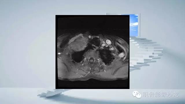 【病例】恶性外周神经鞘瘤2例MR影像表现