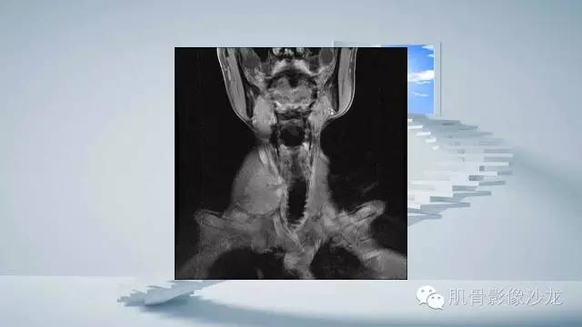 【病例】恶性外周神经鞘瘤2例MR影像表现