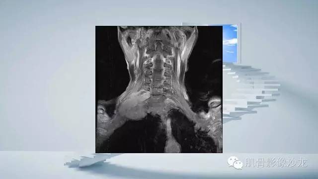 【病例】恶性外周神经鞘瘤2例MR影像表现