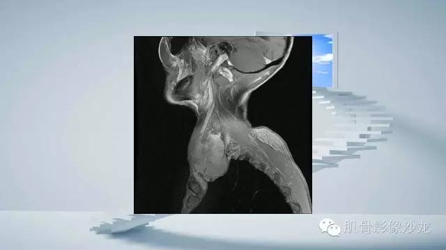 【病例】恶性外周神经鞘瘤2例MR影像表现
