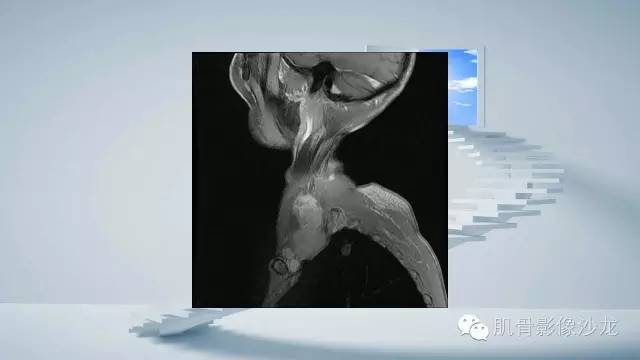 【病例】恶性外周神经鞘瘤2例MR影像表现